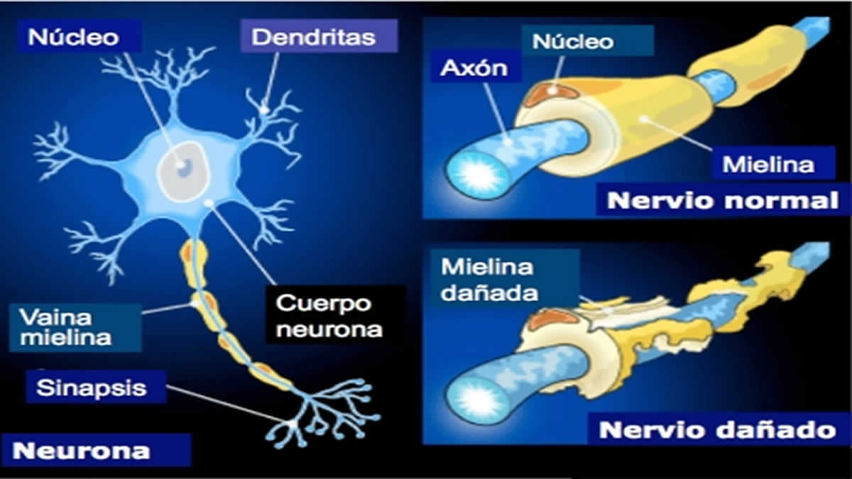 ¿qué Es La Esclerosis Múltiple Viva Nicaragua Canal 13emk 2518